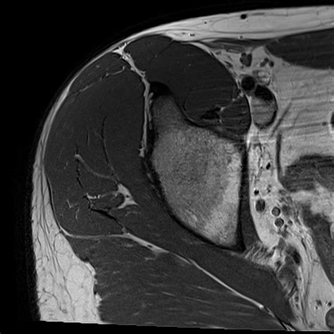 normal hip MRI axial view 4 Diagram | Quizlet