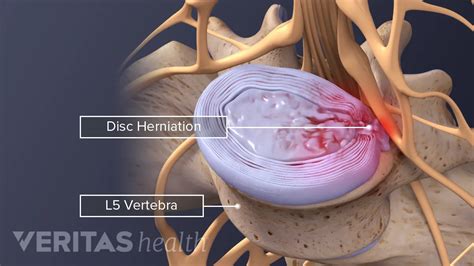 Protrusion L4/5 - Pregnant Health Tips