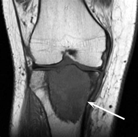 Giant Cell Tumor of Bone - OrthoInfo - AAOS