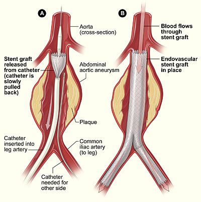 Endovascular aneurysm repair - Wikipedia