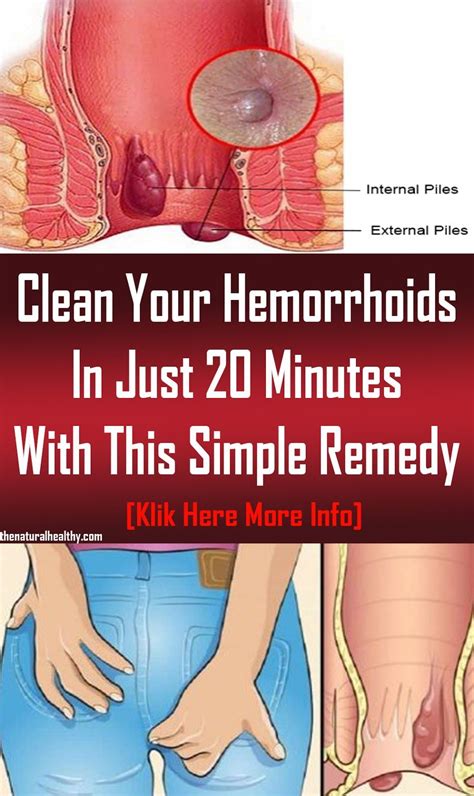 Clean Your Hemorrhoids In Just 20 Minutes With This Simple Remedy ...