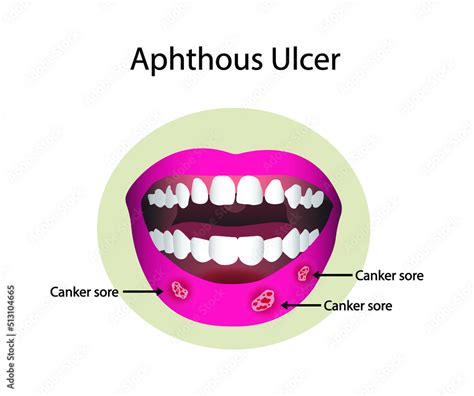 illustration of biology and medical, Aphthous ulcer, Mouth ulcer causes ...