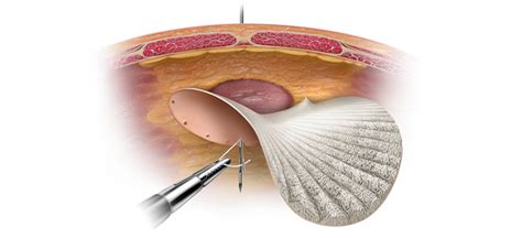 How is the use of Mesh Helpful During a Hernia Surgery? - Neoalta ...