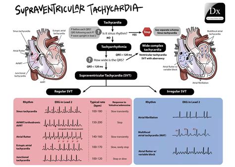 Supraventricular Atrial Tachycardia