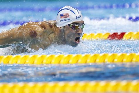 Michael Phelps Cupping Therapy: 5 Fast Facts You Need to Know | Heavy.com