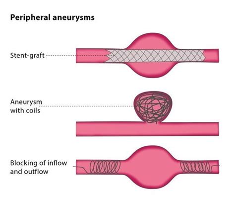 Endovascular treatment of peripheral aneurysms – CIRSE