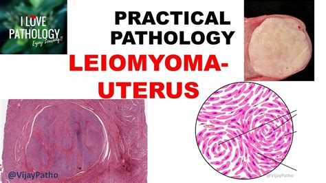 LEIOMYOMA UTERUS: etiology, Clinical features, Gross & Microscopy - YouTube