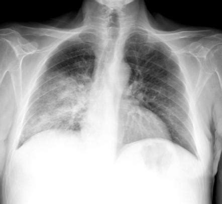 Pulmonary edema | Radiology Reference Article | Radiopaedia.org