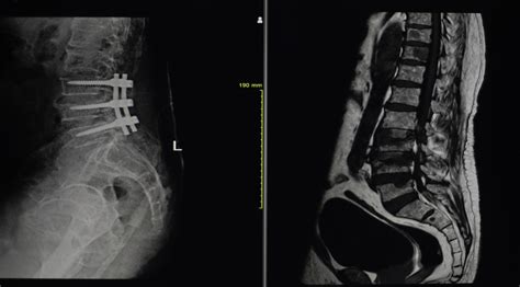 Faster Spinal Fusion Recovery - What Steps to Make?