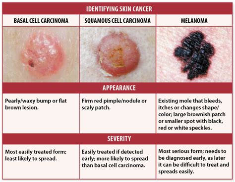 Skin Cancer Signs? Self-Checks May Help You Avoid Deadly Recurrence ...