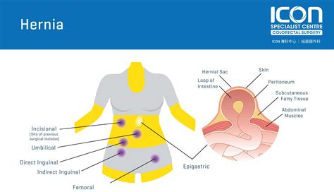 Cirurgia de hérnia abdominal como funciona? Dr. Douglas Bastos Cirurgia ...