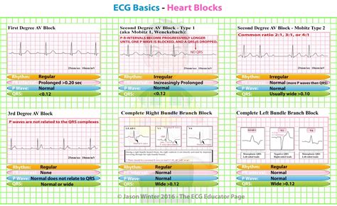 Ecg Blocks Made Easy