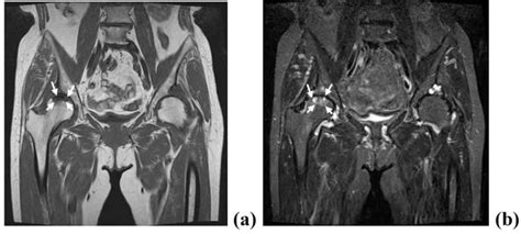 Hip Bone Cyst