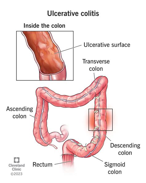 Ulcerative Colitis: Symptoms, Causes, Diagnosis & Treatment