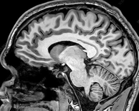 Normal Sagittal Brain Mri