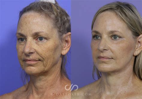 Mini Facelift Before And After