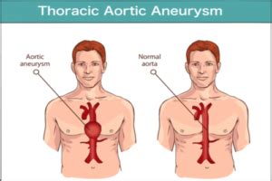 Aneurysm : Definition, symptoms, causes, treatment, & prevention | FactDr