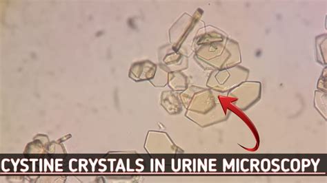 Cystine crystals seen in urine microscopy.Best crystals view in ...