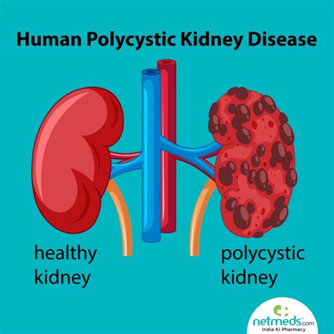 Polycystic Kidney Disease: Causes, Symptoms And Prevention