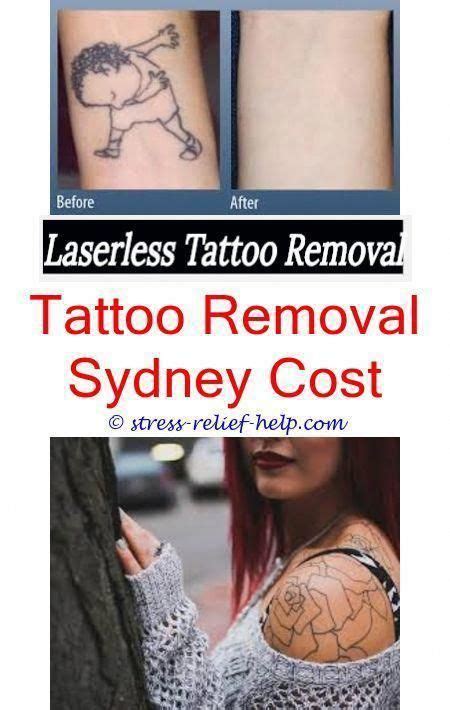 Tattoo removal birmingham.Full tattoo removal.How to do salabrasion ...