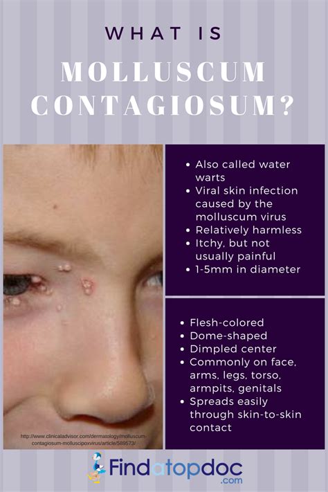 What Is Molluscum Contagiosum? Treatment and Home Remedies