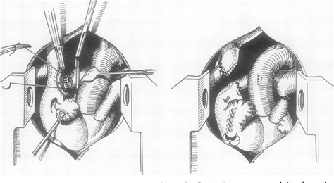 [PDF] Surgical repair of tricuspid atresia. | Semantic Scholar