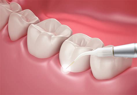 Laser Dentistry: Comfortable, Precise Care in Los Algodones, Mexico