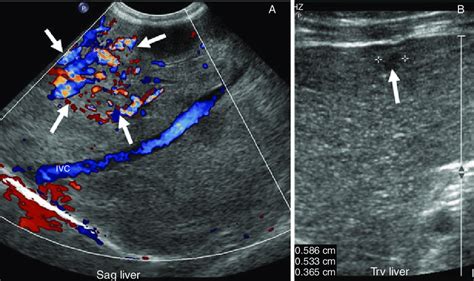 A, Sagittal Duplex/color Doppler ultrasound evaluation of the liver at ...