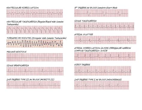 Cardiac Rhythm Examples - Etsy