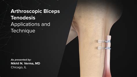 Arthrex - Arthroscopic Biceps Tenodesis: Applications and Technique