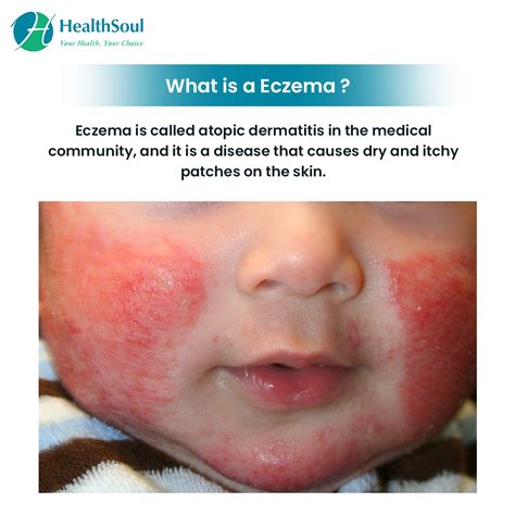 Eczema: Symptoms, Diagnosis and Treatment – Healthsoul