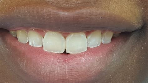 Fixing Gaps Between Front Teeth