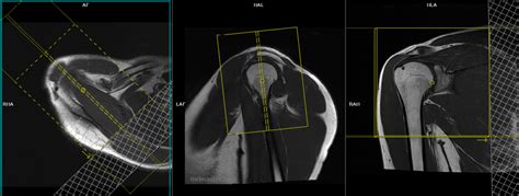 MRI shoulder arthrogram protocols and planning | Indications for MRI