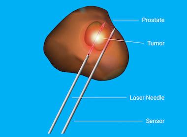 Avenda Health laser platform improves prostate cancer outcomes