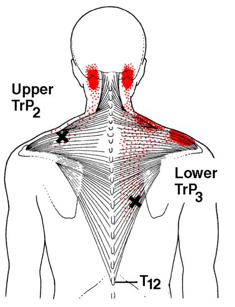 Trapezius Trigger Points Referred Pain