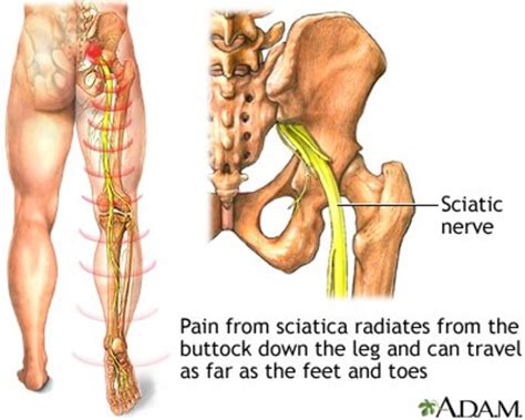 Sciatic Pain - Causes and Treatments - HubPages