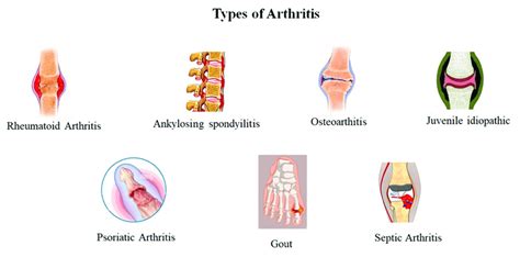 Common types of arthritis reported in the literatures. | Download ...