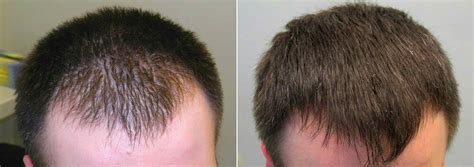 Finasteride Before and After Photos [2023]