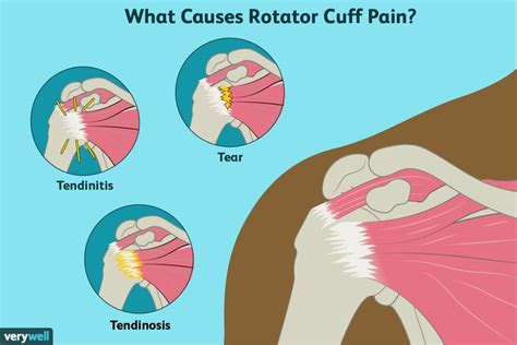 rotator cuff pain causes | Rotator cuff, Rotator cuff pain, Rotator ...