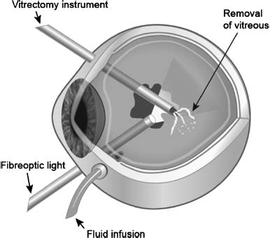 Pars plana vitrectomy. | Download Scientific Diagram