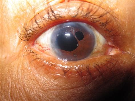 Medical Pictures Info – Coloboma