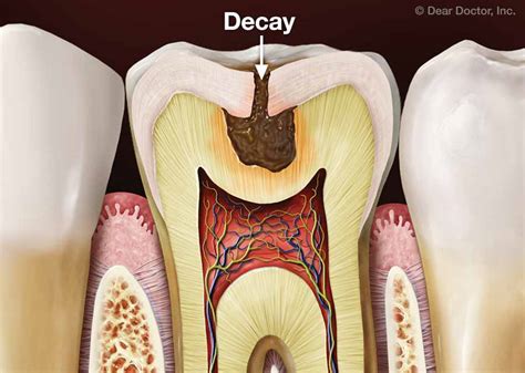 Tooth Decay Prevention | Dr. George P. Cerniglia | Metairie Louisiana