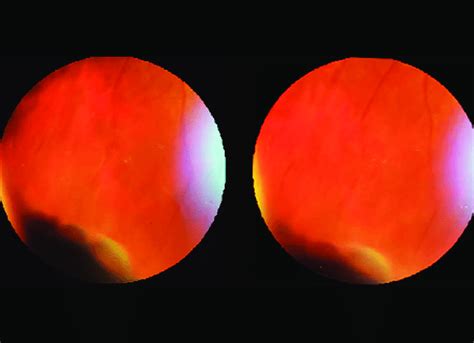 Stereo pair showing pars plana cysts | Download Scientific Diagram