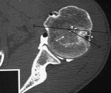 Hill Sachs Lesion - Physiopedia