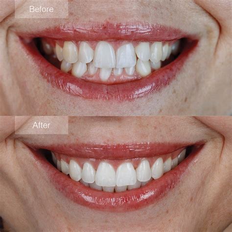 Invisalign Before and After - The Dental Room