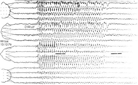 Normal Versus Abnormal Eeg