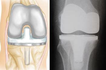 Total Knee Replacement Animation - OrthoInfo - AAOS