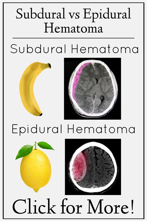 Subdural Vs Epidural Hematoma Symptoms