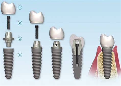 What are dental implants and dental implant procedures?