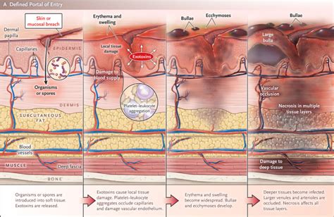 Everything You Ever wanted to Know About Necrotizing Fasciitis - County EM